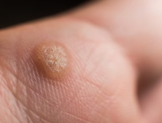 Odciski i brodawki stóp – jak z nimi walczyć i im zapobiegać?